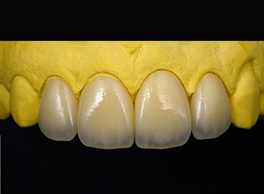 Veneers
