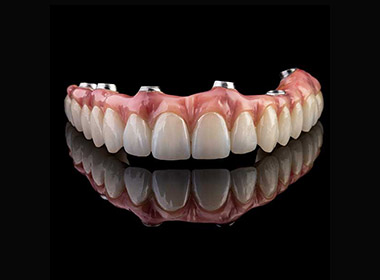 Screw-Retained Bridge